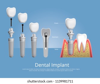 Human teeth and Dental implant Vector Illustration
