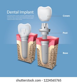 Human teeth and Dental implant Vector Illustration