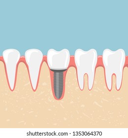 Human teeth and dental implant vector design illustration