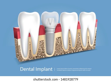 Human teeth and Dental implant Vector Illustration