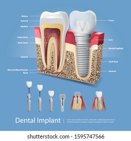 Human teeth and Dental implant Vector Illustration