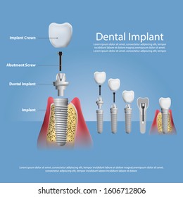 Human teeth and Dental implant Vector Illustration