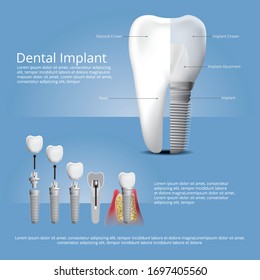 Human teeth and Dental implant Vector Illustration