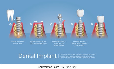 Human Teeth And Dental Implant Vector Illustration