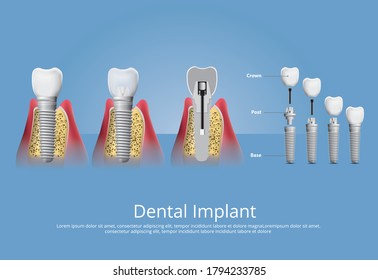 Human Teeth Dental Implant Vector Illustration Stock Vector (Royalty ...