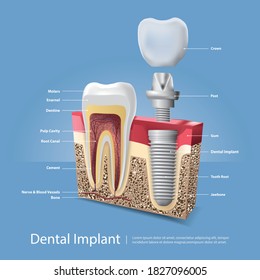 Human teeth and Dental implant Vector Illustration