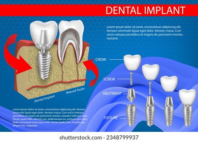 Human teeth and Dental implant Vector Illustration.