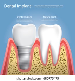 Human teeth and Dental implant Vector Illustration