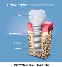 Human Teeth And Dental Implant Vector Illustration