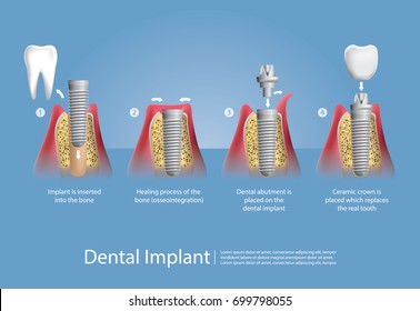 Human Teeth And Dental Implant Vector Illustration