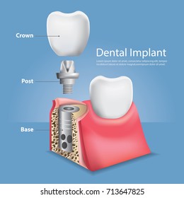 Human teeth and Dental implant Vector Illustration