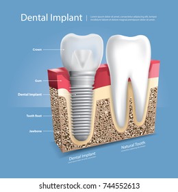 Human teeth and Dental implant Vector Illustration