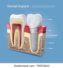 Human teeth and Dental implant Vector Illustration