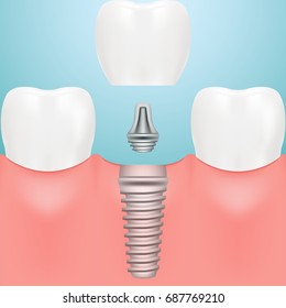 Human Teeth And Dental Implants Isolated On A Background. Vector Illustration. Stomatology. Creative Medical Concept