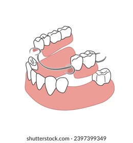 Human teeth with denture.Active Dentures.Vector Dental bridge implant procedure.gum model. false teeth