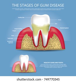 Human teeth Gum Disease and Healthy Gum Vector Illustration