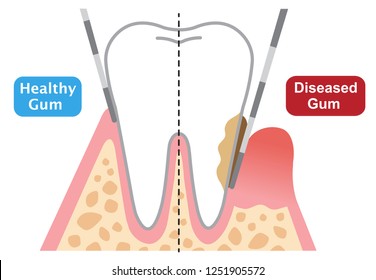 human teeth of gum disease and normal teeth illustration isolated on white background. dental and health care concept
