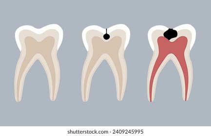  Human teeth. Healthy and with caries. The tooth is incised.
