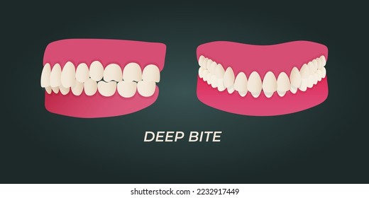 Human teeth malocclusion set with realistic images of mouth jaws with crooked teeth and text captions. Normal and abnormal occlusion. Vector illustration