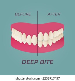 Human teeth malocclusion set with realistic images of mouth jaws with crooked teeth and text captions. Normal and abnormal occlusion. Vector illustration