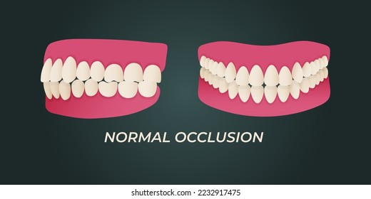 Maloclusión dentaria humana con imágenes realistas de mandíbulas bucales con dientes torcidos y leyendas de texto. Conclusión normal y anormal. Ilustración del vector