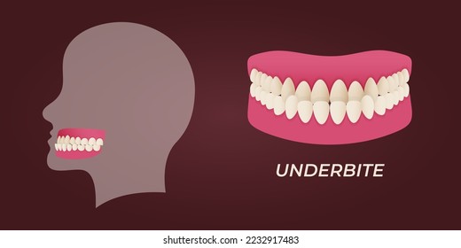 Human teeth malocclusion set with realistic images of mouth jaws with crooked teeth and text captions. Normal and abnormal occlusion. Vector illustration