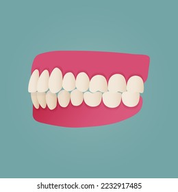 Human teeth malocclusion set with realistic images of mouth jaws with crooked teeth and text captions. Normal and abnormal occlusion. Vector illustration