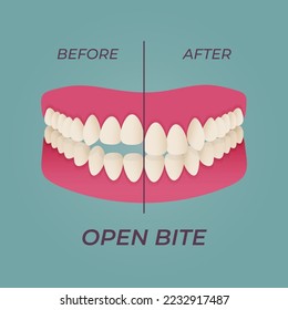Human teeth malocclusion set with realistic images of mouth jaws with crooked teeth and text captions. Normal and abnormal occlusion. Vector illustration
