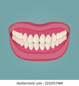 Human teeth malocclusion set with realistic images of mouth jaws with crooked teeth and text captions. Normal and abnormal occlusion. Vector illustration