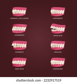 Human teeth malocclusion set with realistic images of mouth jaws with crooked teeth and text captions. Normal and abnormal occlusion. Vector illustration