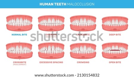 Human teeth malocclusion set with realistic images of mouth jaws with crooked teeth and text captions vector illustration