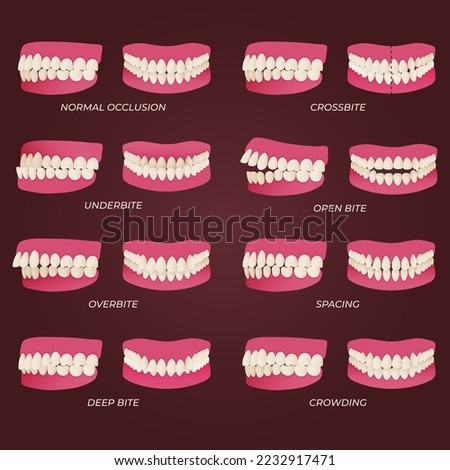 Human teeth malocclusion set with realistic images of mouth jaws with crooked teeth and text captions. Normal and abnormal occlusion. Vector illustration