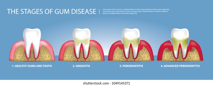 Human teeth Stages of Gum Disease Vector Illustration