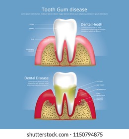 Human teeth Stages of Gum Disease Vector Illustration