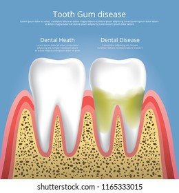 Human teeth Stages of Gum Disease Vector Illustration