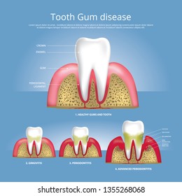 Human teeth Stages of Gum Disease Vector Illustration