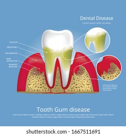 Human teeth Stages of Gum Disease Vector Illustration