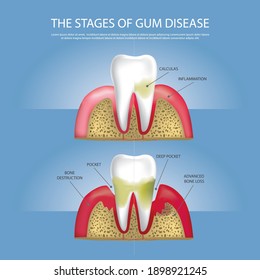 Human teeth Stages of Gum Disease Vector Illustration