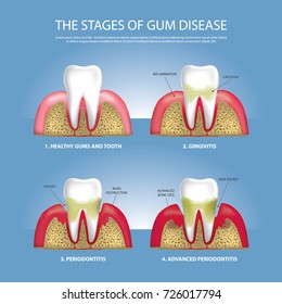 Human teeth Stages of Gum Disease Vector Illustration