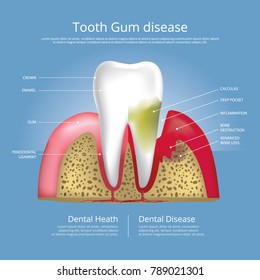 Human teeth Stages of Gum Disease Vector Illustration