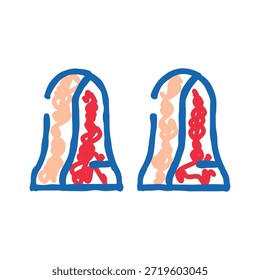 Icono de amígdalas humanas que muestra inflamación e infección roja en la garganta, ilustrando el concepto de amigdalitis y afecciones médicas que afectan la faringe