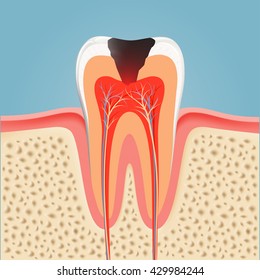 Human tooth with caries. Stock vector illustration.