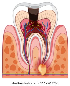 A Human Tooth Decay and Cavity illustration