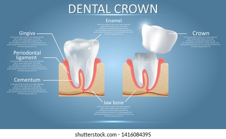 Human tooth and dental crown diagram. Vector educational poster, medical infographic, presentation template. Crown restoration dental procedure concept.