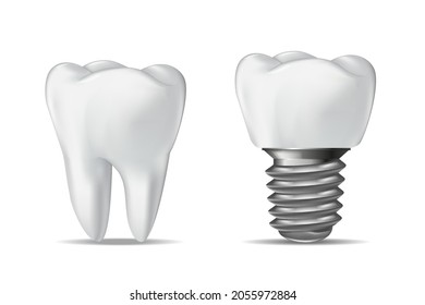 Human Tooth and Dental Implant, dental concept, realistic vector illustration