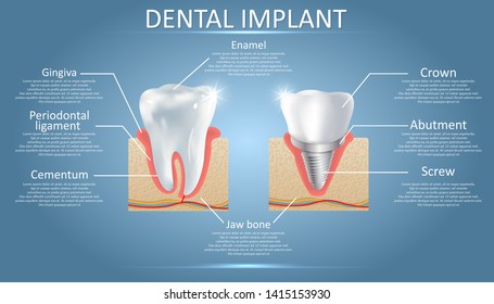 Human Tooth And Dental Implant With Crown Attached Diagram. Vector Educational Poster, Medical Infographic, Presentation Template. Dental Implant Procedure Concept.