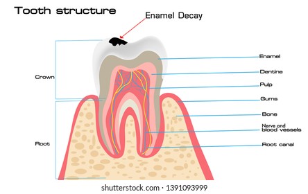 Human tooth structure vector diagram and caries stages. Dental anatomy and tooth decay or cavities development concept. Training medical anatomical poster