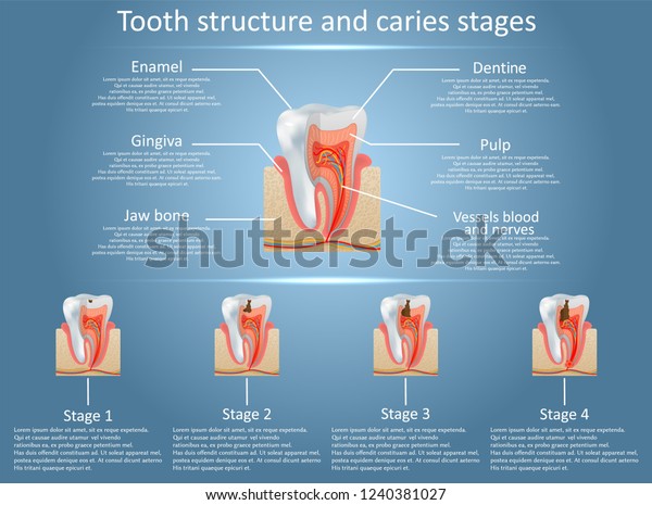 Human tooth structure vector diagram\
and caries stages. Dental anatomy and tooth decay or cavities\
development concept. Training medical anatomical\
poster.