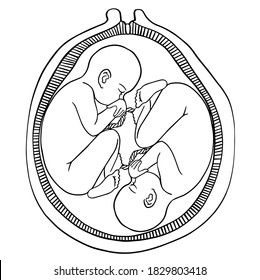 Human twins fetus concept hand drawn vector illustration prenatal growing baby, umbilicle cord isolated on a white background as an obstetric medicine symbol for pregnancy health and fetal healthcare