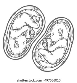 Human twins fetus concept hand drawn vector illustration prenatal growing baby, umbilicle cord isolated on a white background as an obstetric medicine symbol for pregnancy health and fetal healthcare 